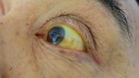 Olhos amarelados: o que pode ser?