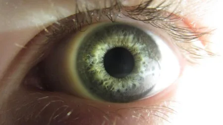 Celulite ocular deve ser tratada rapidamente