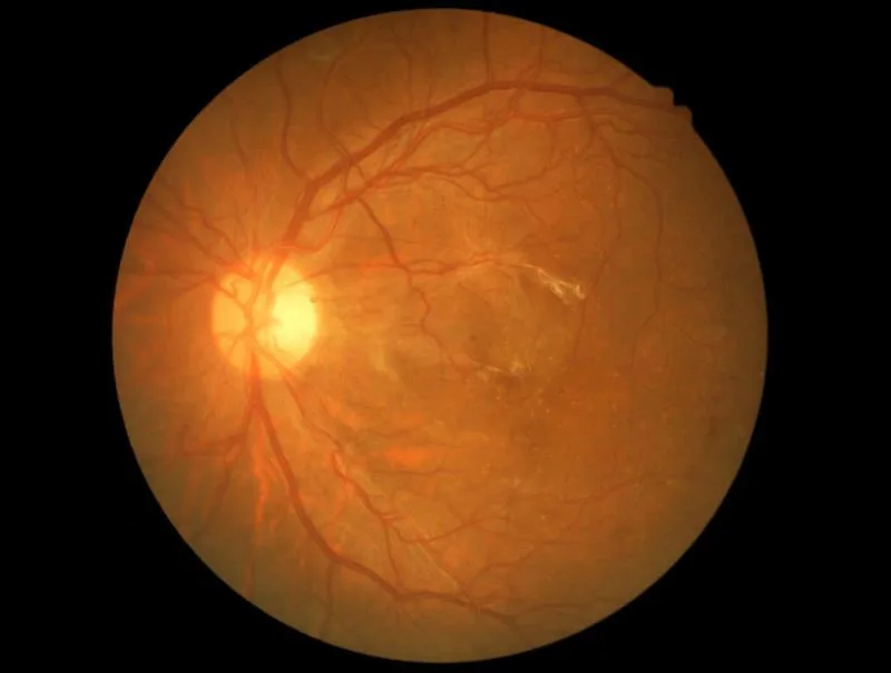 Retinopatia diabetica