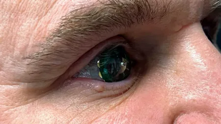 Lentes de Contato Inteligentes
