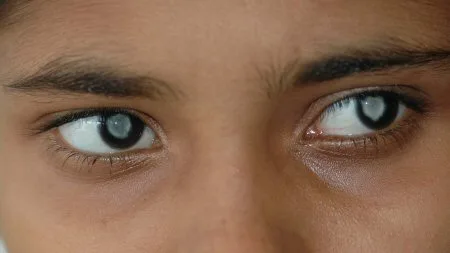 Em 2022 catarata atingiu mais mulheres