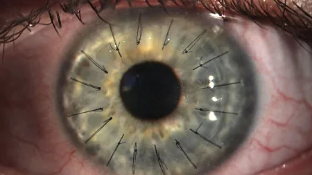 I Fórum Nacional de Transplante de Tecidos Oculares
