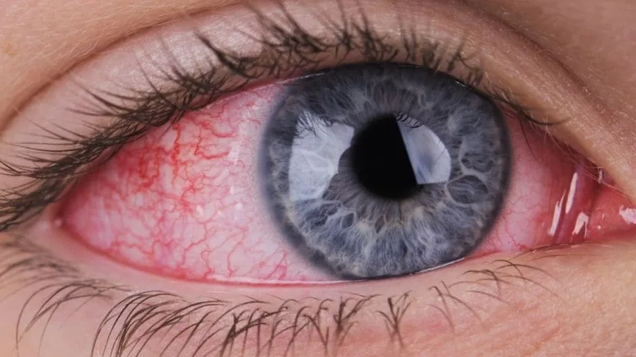 Entenda as principais causas para irritações nos olhos
